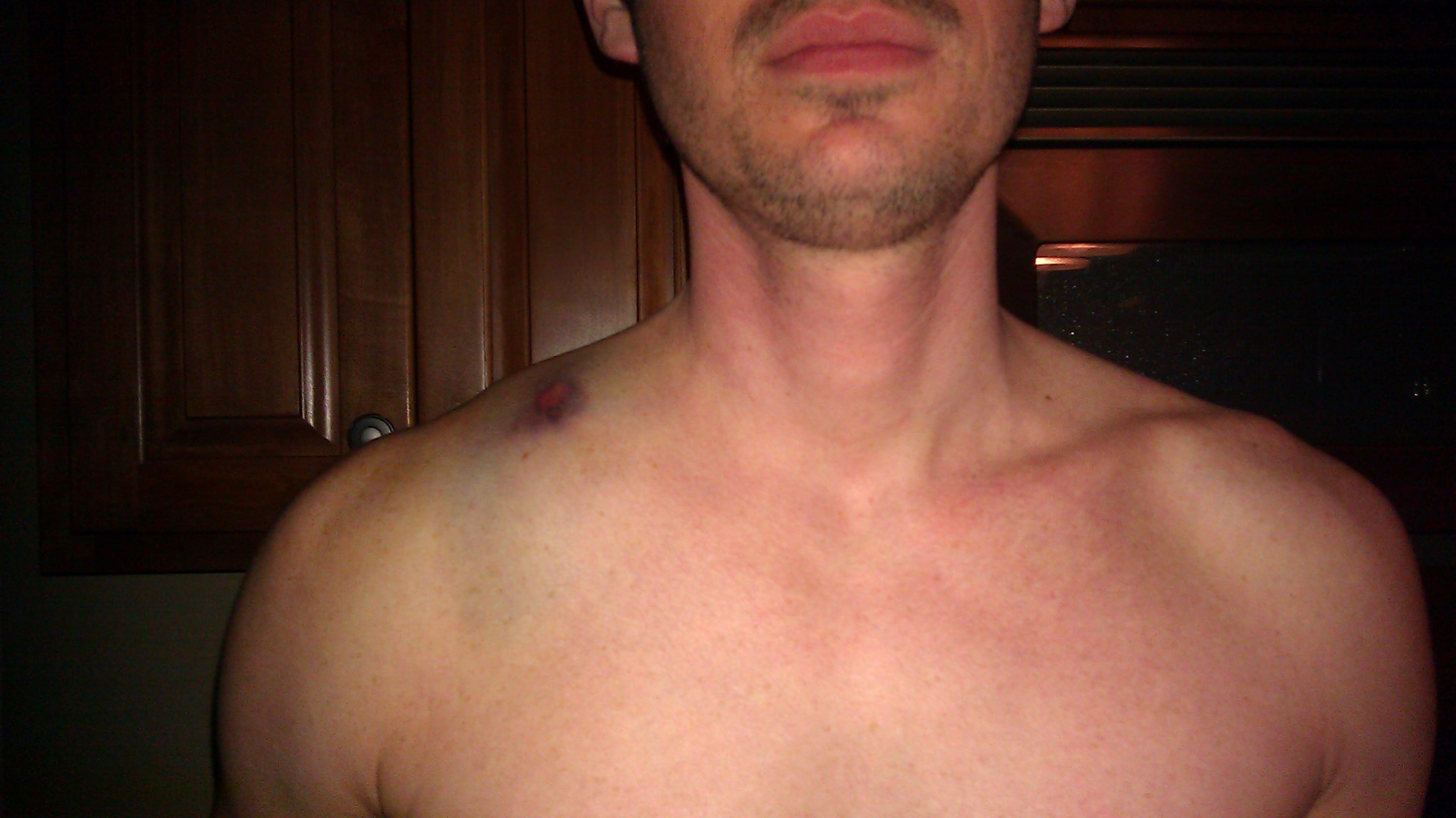 Chads Broken Clavicle Sweep Tight